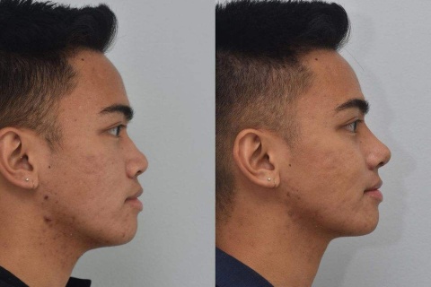 rhinoplasty with rib