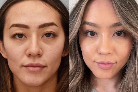 rhinoplasty and eyelid surgery
