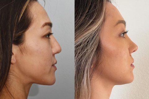rhinoplasty and eyelid surgery
