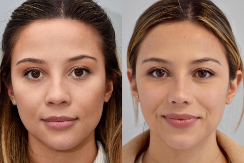 rhinoplasty with rib