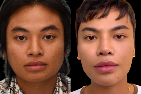 rhinoplasty with rib, chin implant, and jaw reduction