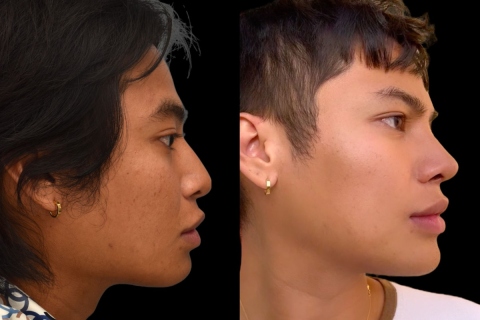 rhinoplasty with rib, chin implant, and jaw reduction