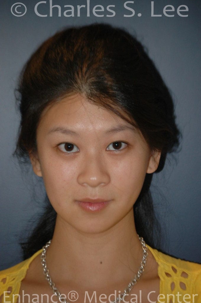 Asian Eyelid Surgery Patient Before 2