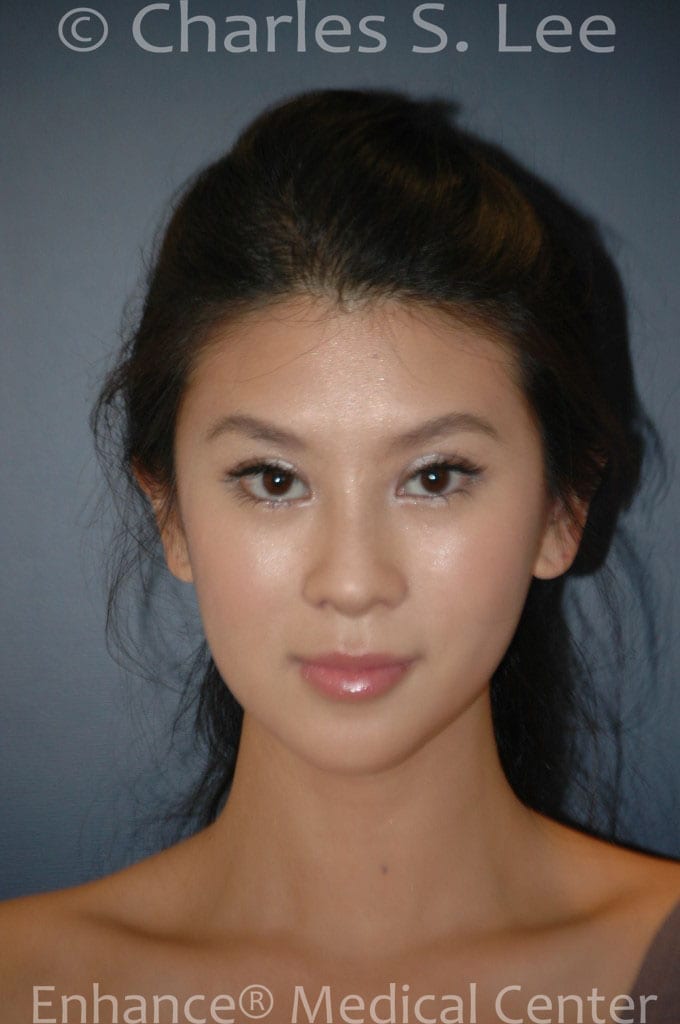 Asian Eyelid Surgery Patient After 2