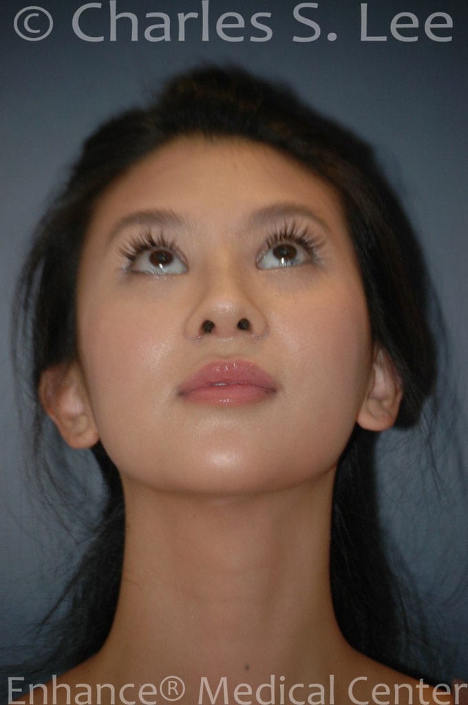 Asian Eyelid Surgery Patient After 4