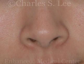 Nostril Narrowing Patient Before