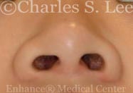 Nostril Narrowing Patient Before 2
