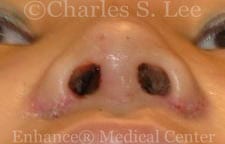 Nostril Narrowing Patient After 2