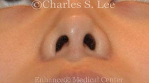 Nostril Narrowing Patient After 3