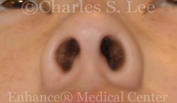 Nostril Narrowing Patient Before 4