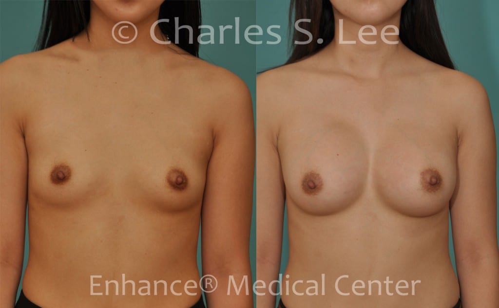 Breast augmentation using saline implants