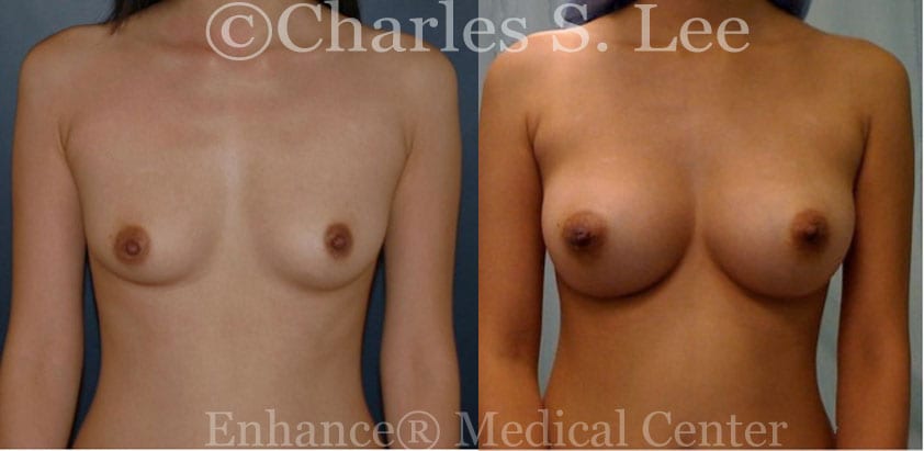 Breast Augmentation Patient Front View