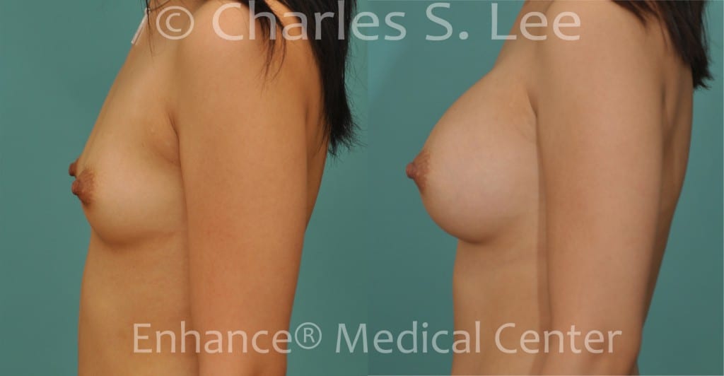 Actual Breast Patient Left Side View