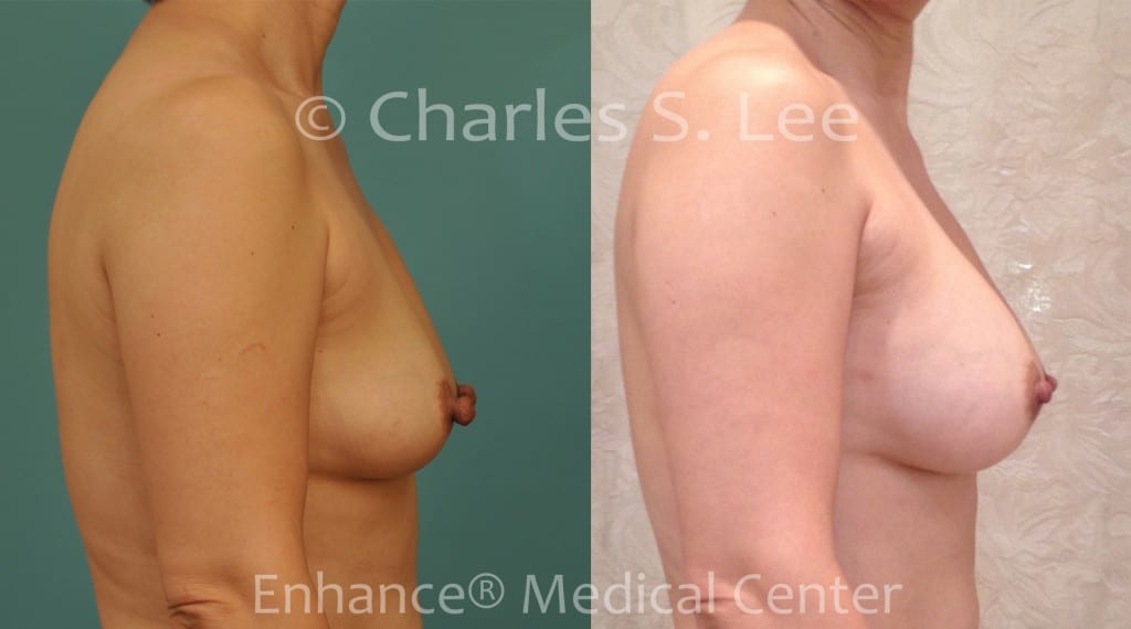 Breast Augmentation with Nipple Reduction Right Side View