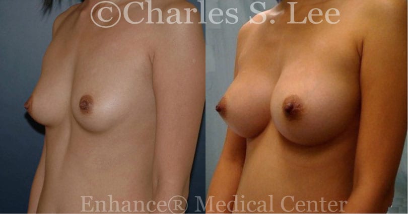 Breast Augmentation Patient Left View