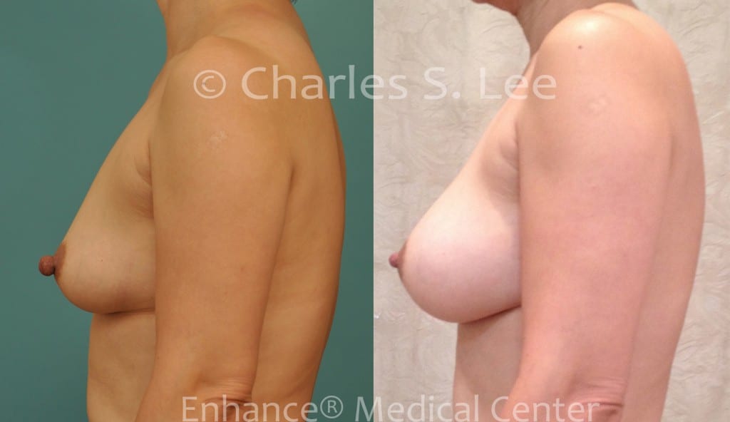 Breast Augmentation with Nipple Reduction Left Side View