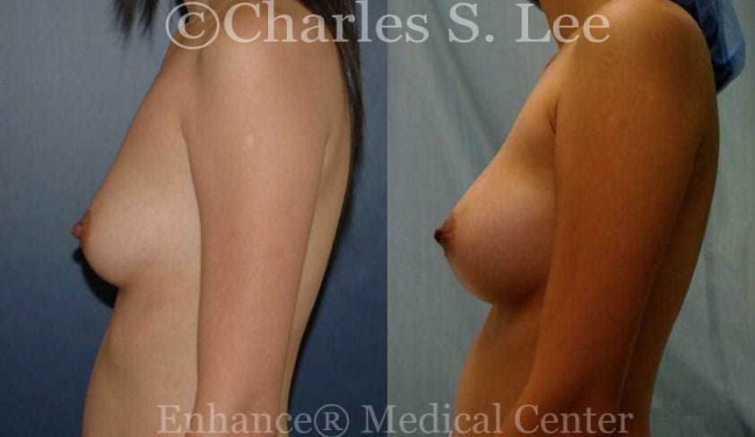 Breast Augmentation Patient Left Side View