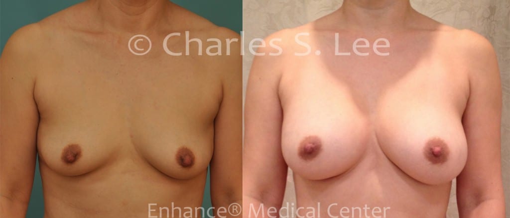 Breast Augmentation with Nipple Reduction Front View