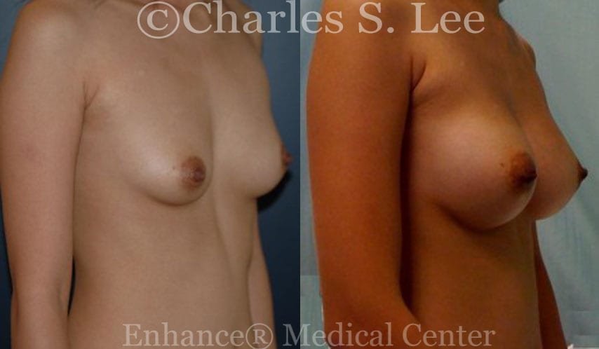 Breast Augmentation Patient Right View