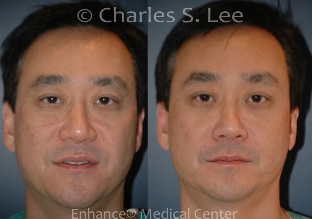Before and After results