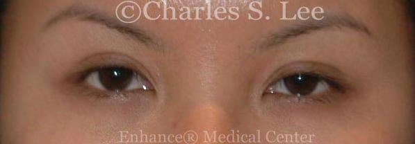 Asian double eyelid plastic surgery patient before 3