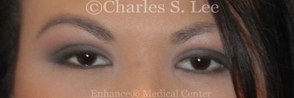 Asian double eyelid plastic surgery patient after 4