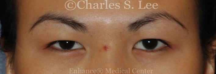 Asian double eyelid plastic surgery patient before 4