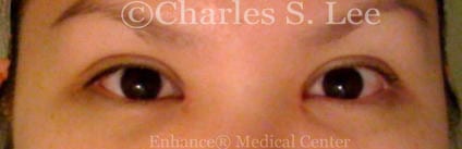 Asian double eyelid plastic surgery patient after 5