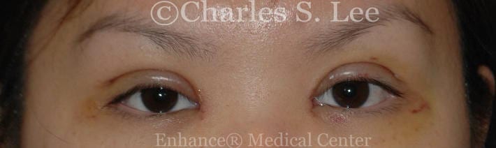Asian double eyelid plastic surgery patient before 5 swelling