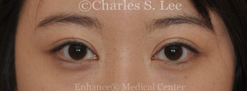 Asian double eyelid plastic surgery patient after