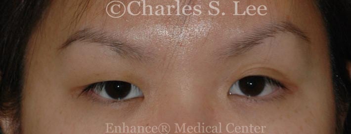 Asian double eyelid plastic surgery patient before 5