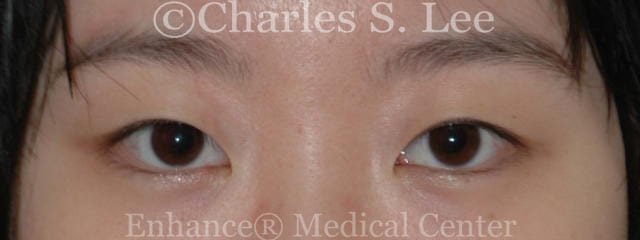Asian double eyelid plastic surgery patient before