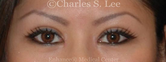 Asian double eyelid plastic surgery patient after 2