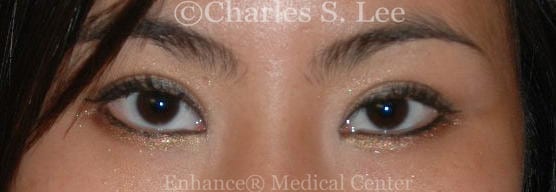 Flowers Anchor blepharoplasty