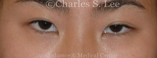 Anchor technique is ideal for reoperation after suture eyelid surgery