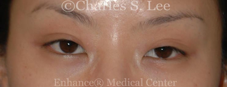 Prior double eyelid surgery with loss of crease