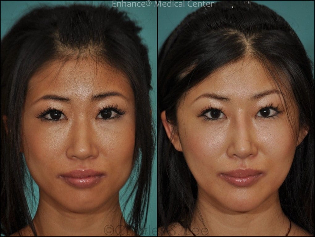Before and After Asian Rhinoplasty Front View