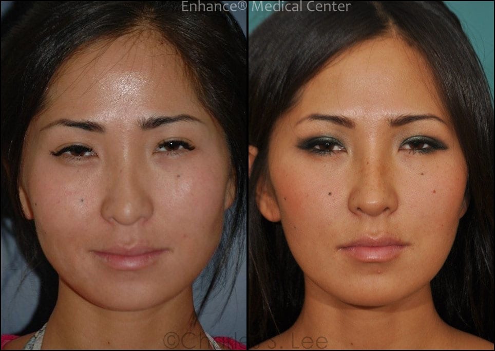 Before and After Asian Rhinoplasty Front View