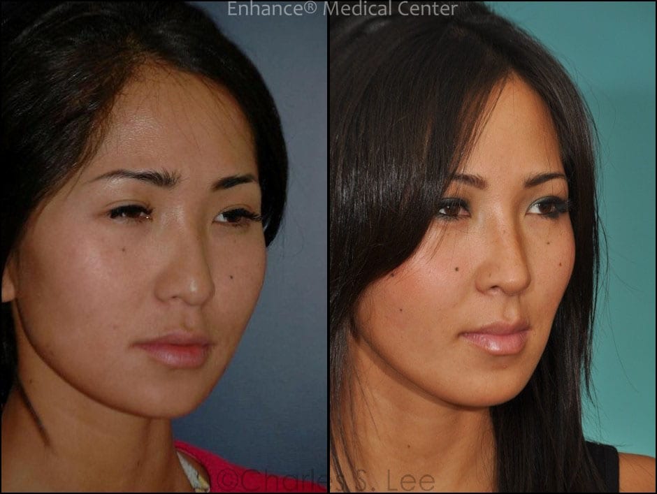 Before and After Asian Rhinoplasty Oblique View