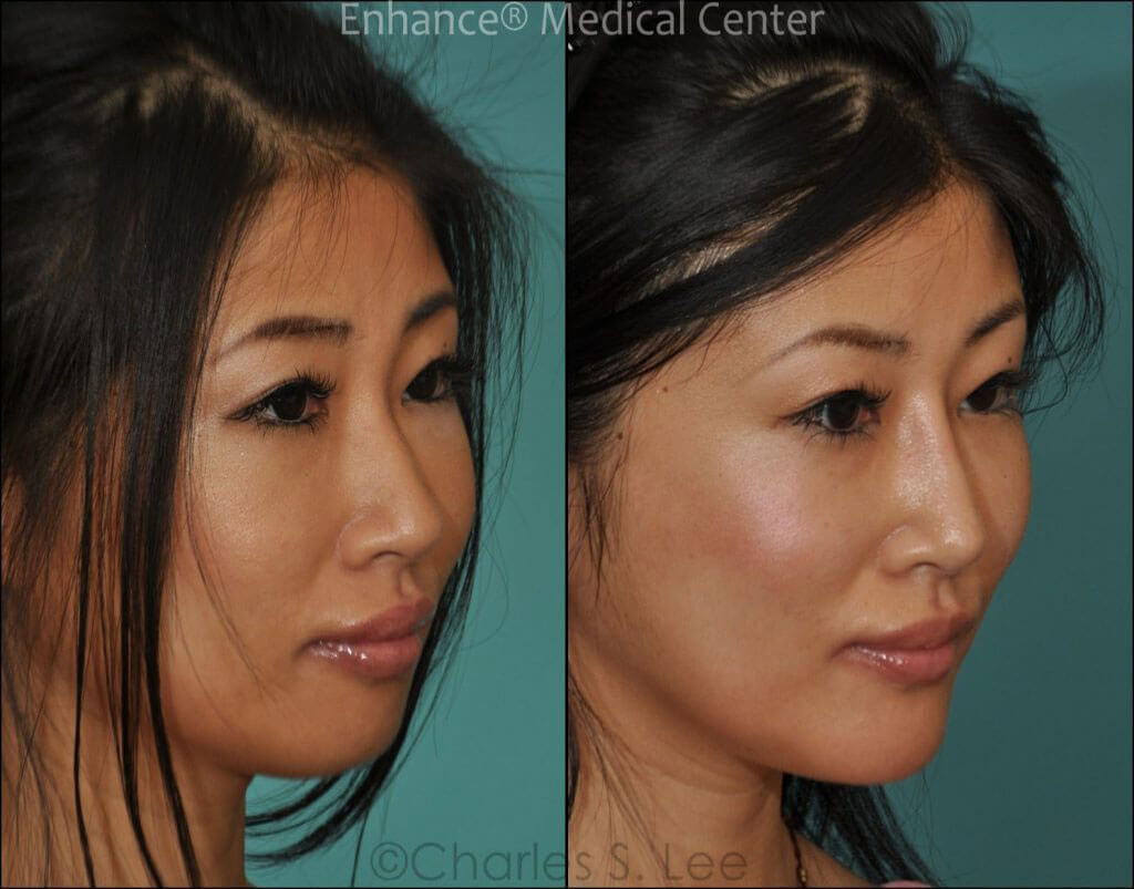 Before and After Asian Rhinoplasty Oblique View