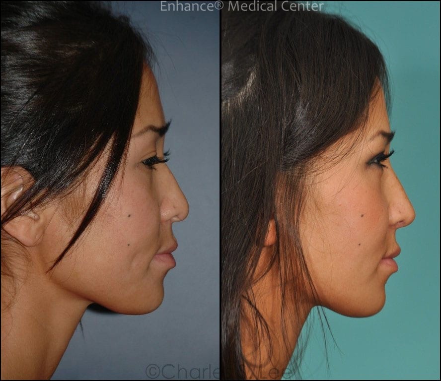 Before and After Asian Rhinoplasty Side View