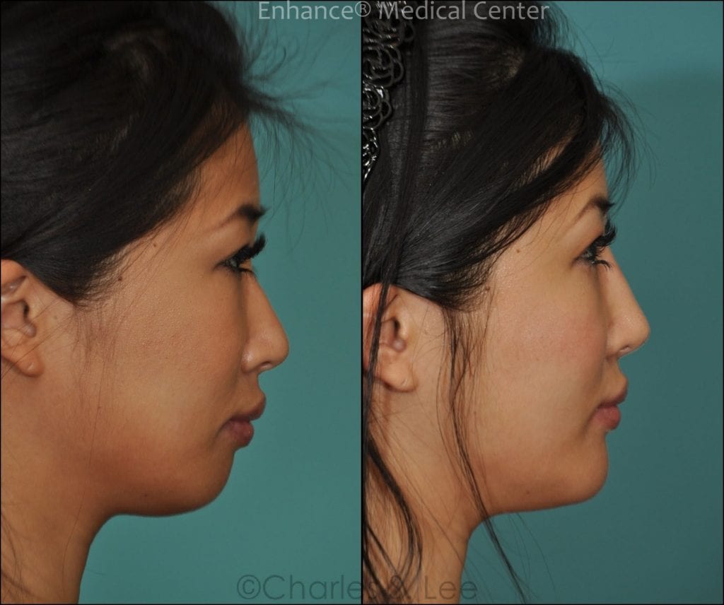 Before and After Asian Rhinoplasty Side View