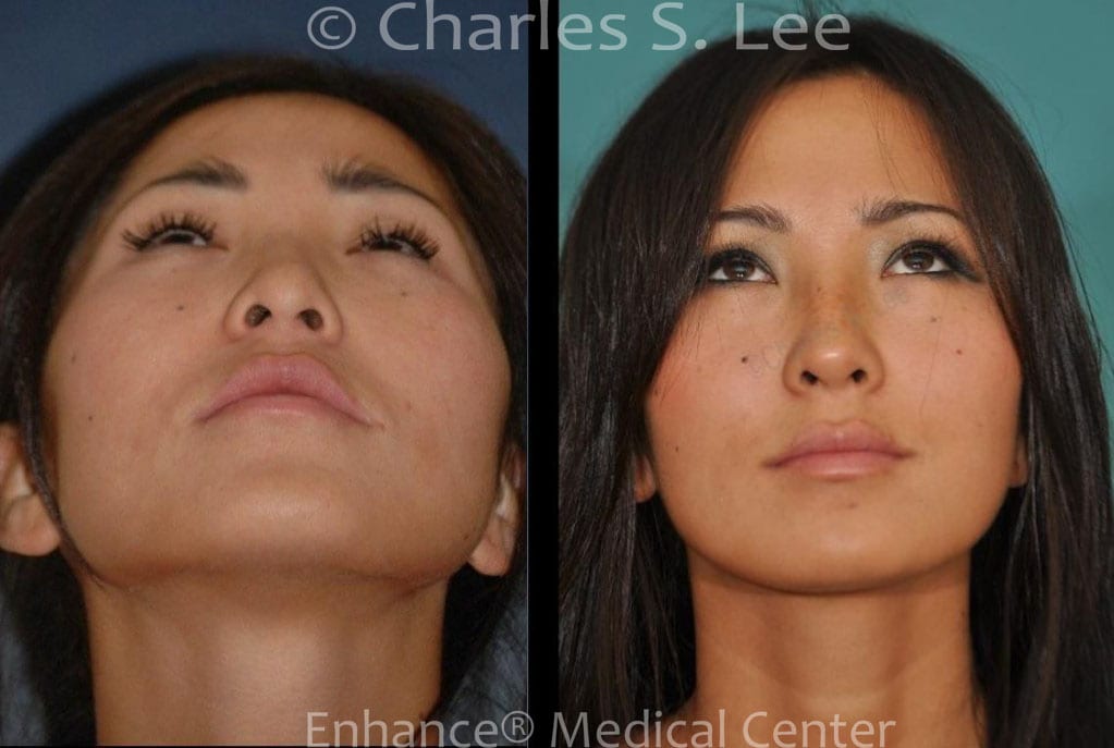 Before and After Asian Rhinoplasty Nostril View