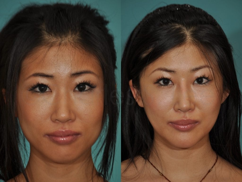 Mom surgical nose job asian bridge photo