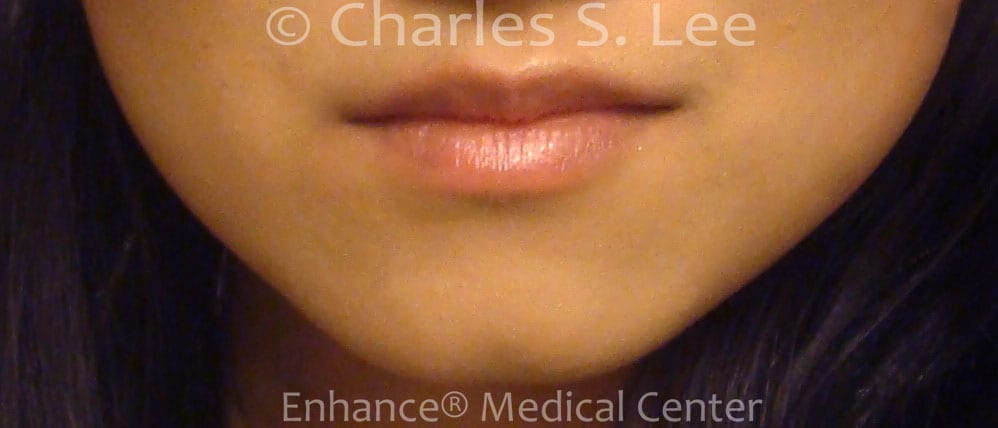 Jawline Reduction Actual Patient After Front View