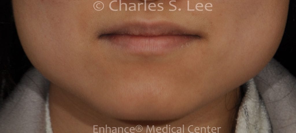 Jawline Reduction Actual Patient Before Front View