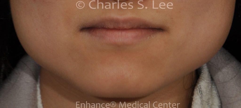 Jawline Reduction Actual Patient Before Front View