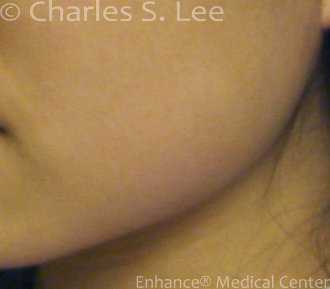 Jawline Reduction Actual Patient After Close 2