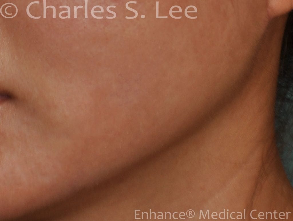 A natural appearing curved shape is easier to obtain through this behind-ear approach