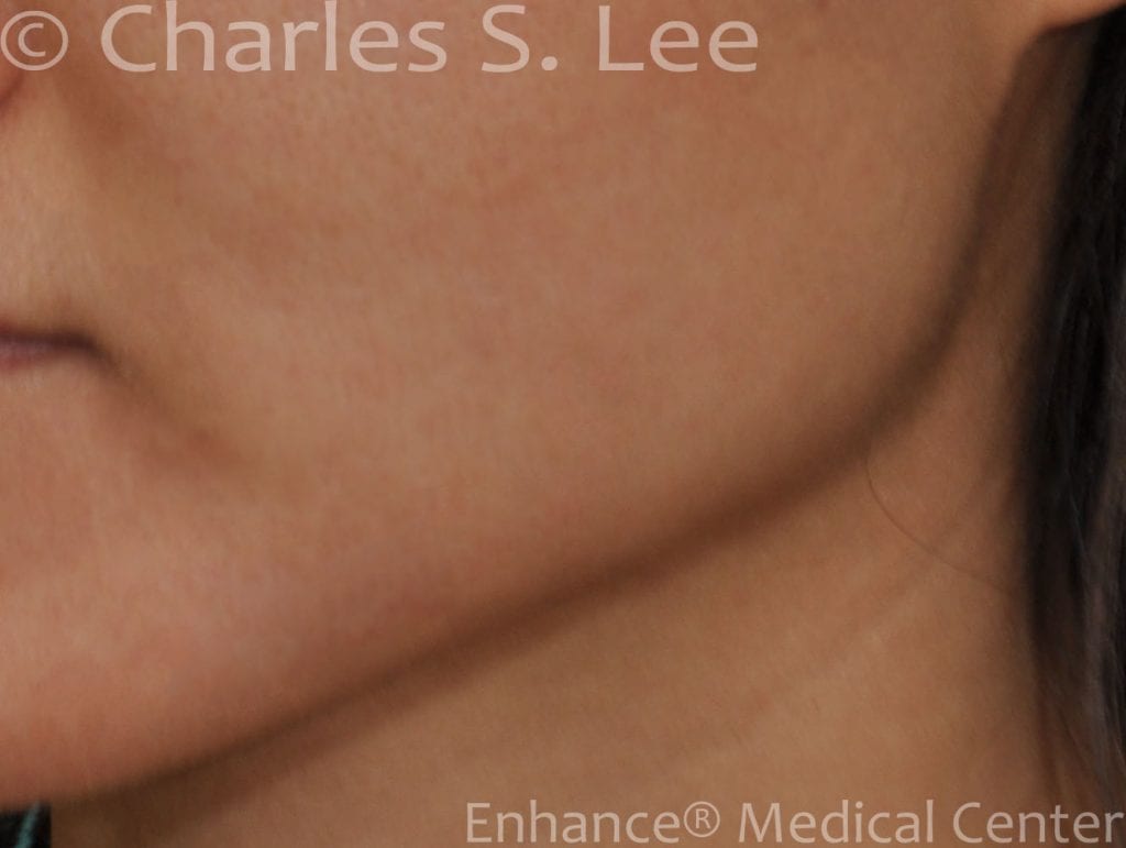 Jawline Reduction Actual Patient Before Close Up